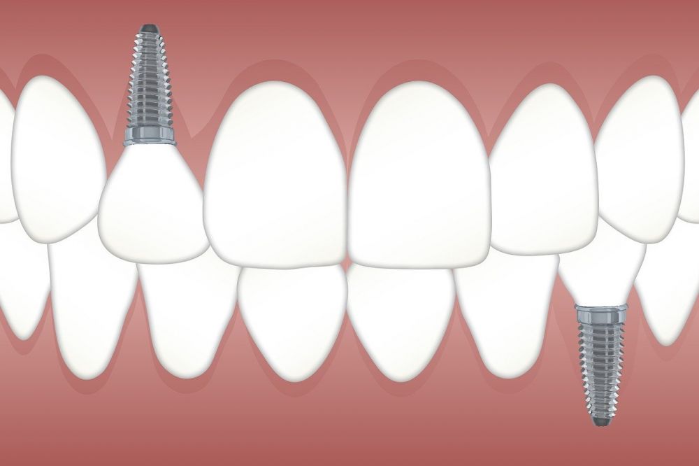 Tandimplantater: Det moderne svar på tabte tænder